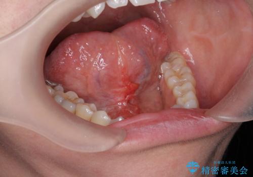 滑舌を改善したい　舌小帯の形成術の症例 治療後