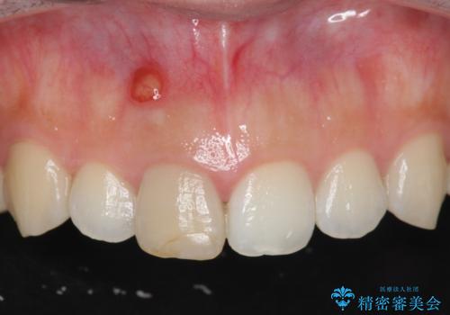 歯ぐきにできものができた　前歯の色調改善の治療前