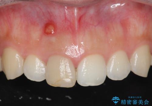 歯ぐきにできものができた　前歯の色調改善の症例 治療前