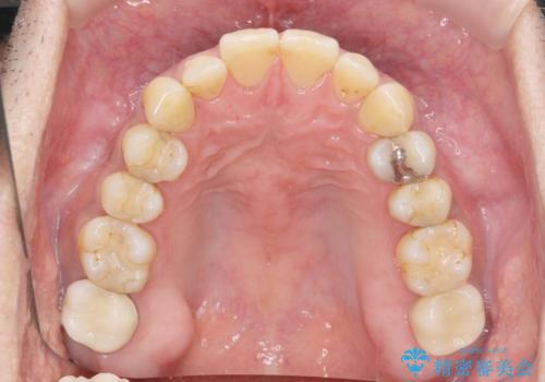 歯ぎしり　いびきに効果的なスプリントナイトガードの症例 治療前