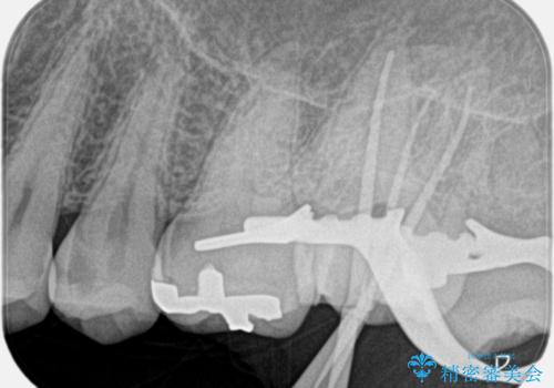 【精密根管治療】奥歯がズキズキ痛い。の治療中