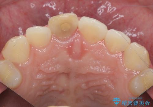 歯ぐきにできものができた 前歯の色調改善の治療前