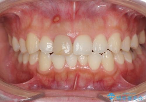 歯ぐきにできものができた 前歯の色調改善の治療前