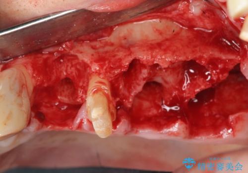 骨の造成を行った上顎インプラント治療の治療前