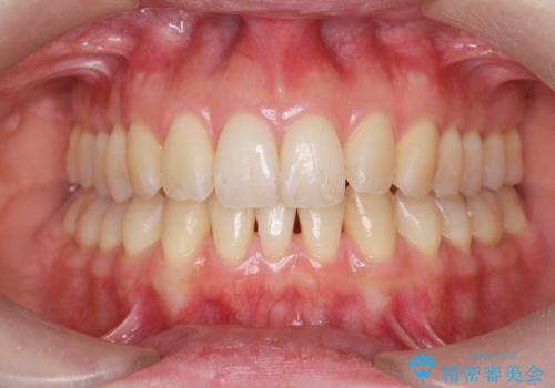 目立つ前歯のガタつきを改善! マウスピース矯正治療の症例 治療後