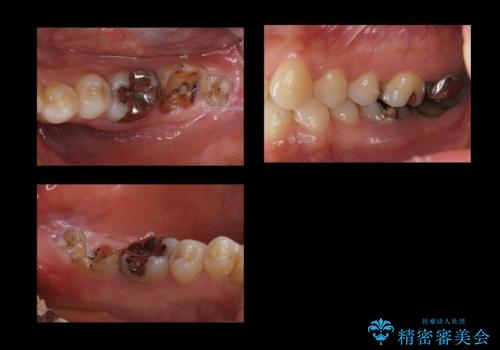 歯科でトラウマ 怖くて行っていなかったが、今度こそきちんと治療したいの症例 治療前