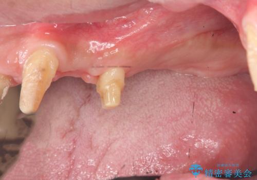 骨の造成を行った上顎インプラント治療の治療中