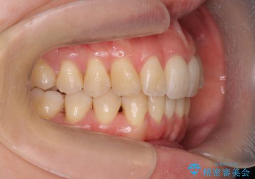 目立つ前歯のガタつきを改善! マウスピース矯正治療の治療後
