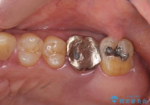 強い咬合力に対抗する歯周補綴の治療前