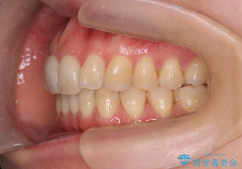 目立つ前歯のガタつきを改善! マウスピース矯正治療の治療後