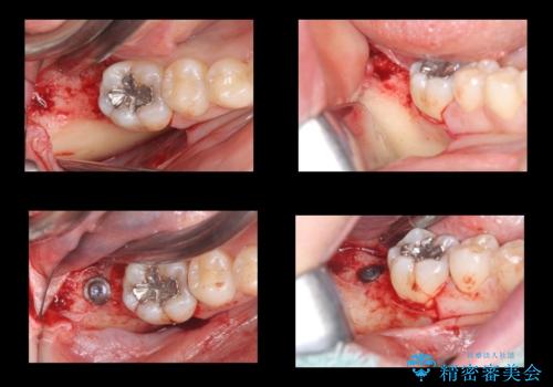 歯科でトラウマ 怖くて行っていなかったが、今度こそきちんと治療したいの治療中