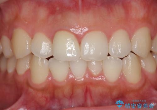 歯ぐきにできものができた　前歯の色調改善の治療後