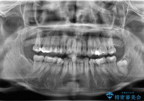 【埋伏智歯と埋伏智歯の過剰歯の抜歯】埋まっている親知らず2本の抜歯の治療前
