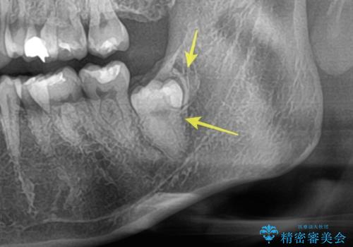 【埋伏智歯と埋伏智歯の過剰歯の抜歯】埋まっている親知らず2本の抜歯の症例 治療前