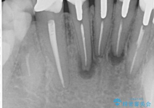 【オールセラミック】下の前歯が痛い。の治療前