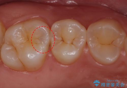 歯と歯の間の虫歯　セラミックインレーでの治療