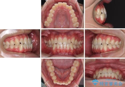 受け口傾向の咬み合わせ インビザラインできれいな口元にの治療前