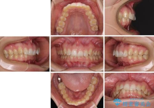 カリエール・ディスタライザーとインビザラインを用いた前歯の咬み合わせ改善の治療前