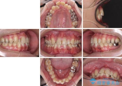重なって磨きにくい上下の前歯 ワイヤー装置での抜歯矯正の治療前