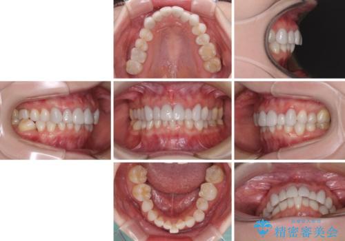 前歯のデコボコと奥歯の咬み合わせをインビザラインで改善の治療前