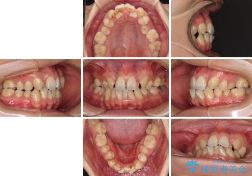 重なり合って磨きにくい前歯 ワイヤー装置での抜歯矯正の治療前