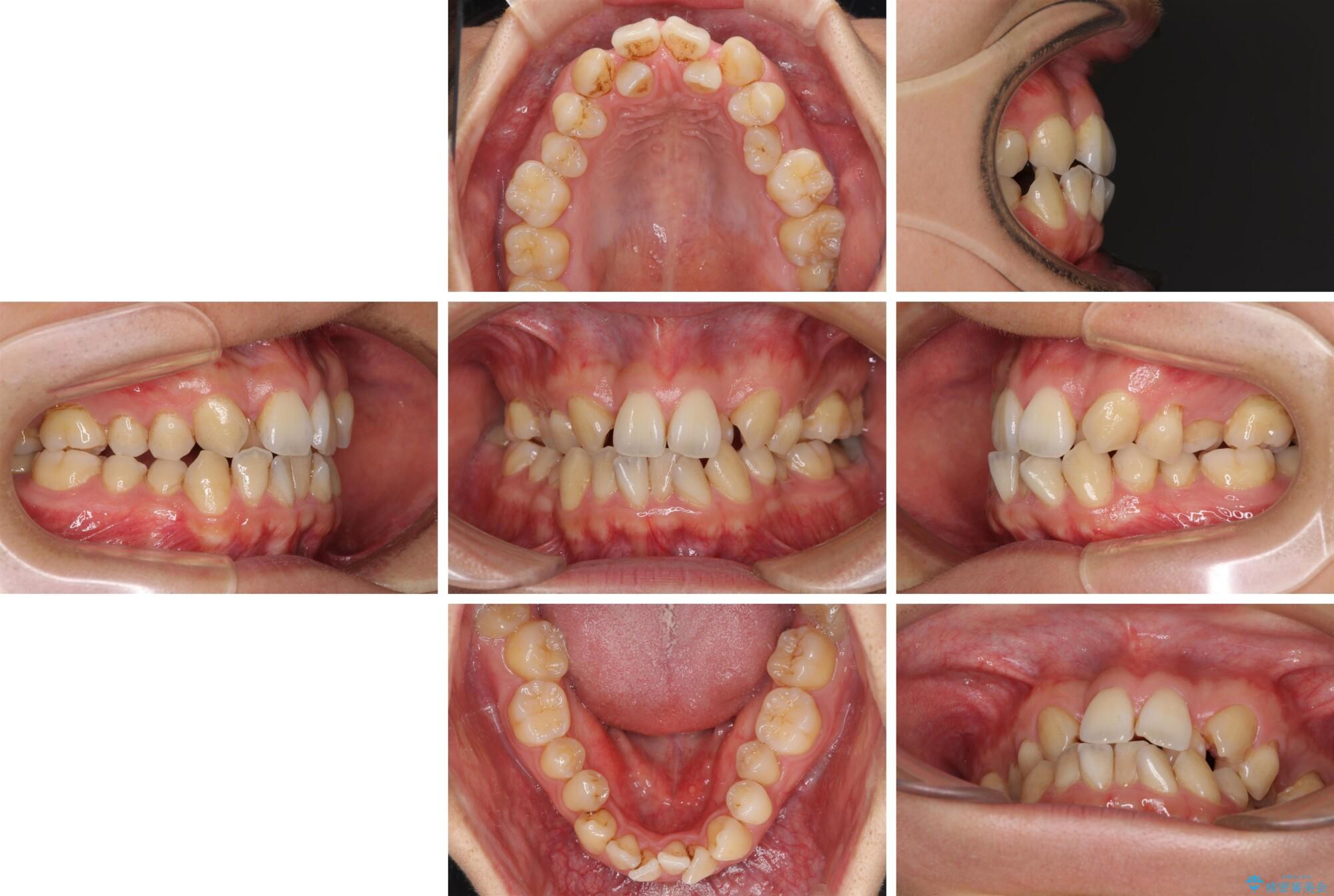 重なり合って磨きにくい前歯　ワイヤー装置での抜歯矯正の症例写真重なり合って磨きにくい前歯　ワイヤー装置での抜歯矯正