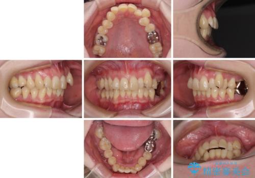 八重歯と先天欠損の歯列 ワイヤー矯正ですっきりとの治療前