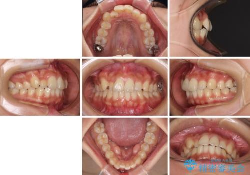 【モニター】歯列が狭くデコボコが気になる 急速拡大装置を用いたインビザライン矯正の治療前