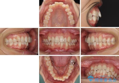 前歯のデコボコを抜歯矯正で改善 メタル装置で費用を抑えるの治療前