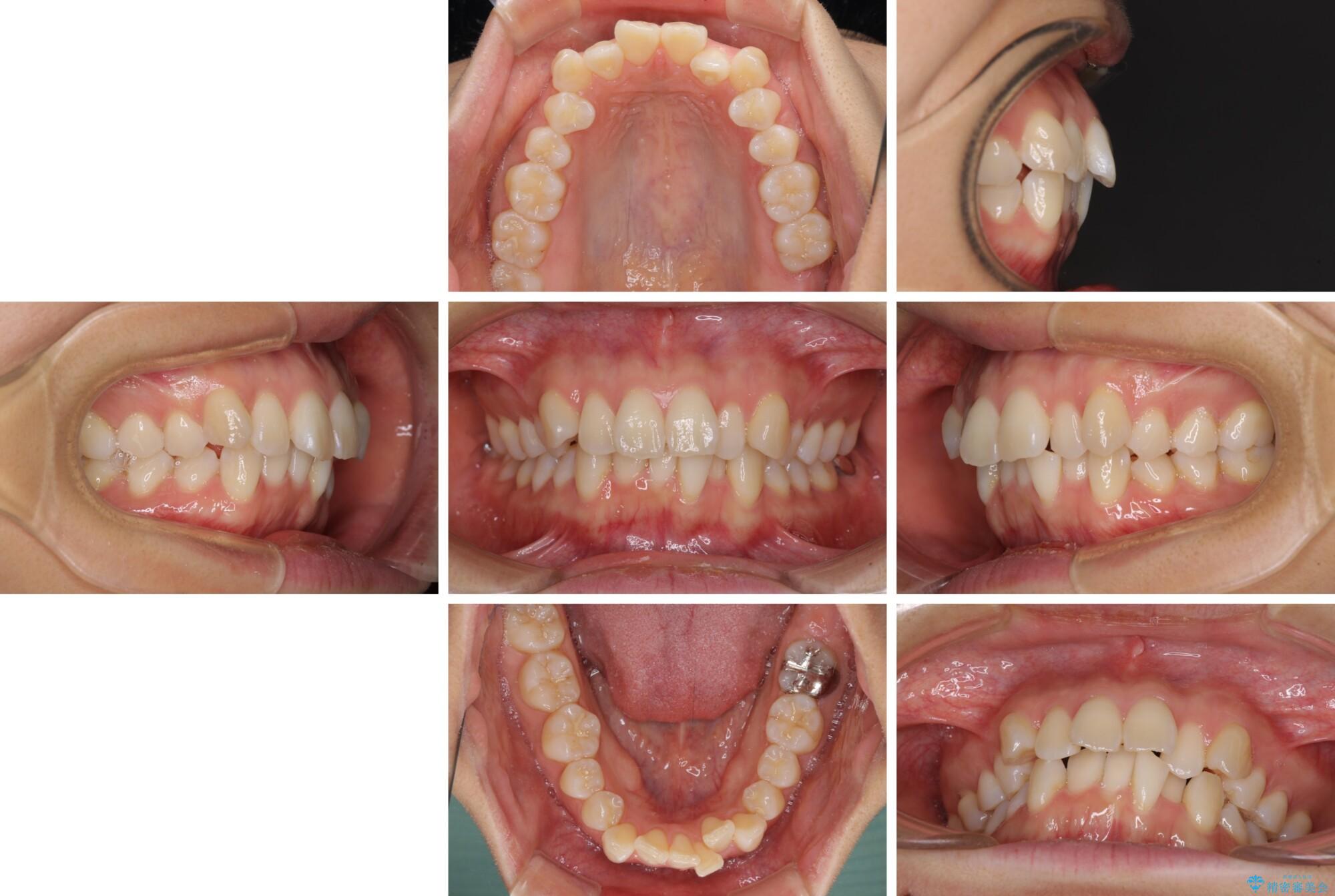 前歯のデコボコを抜歯矯正で改善　メタル装置で費用を抑えるの症例写真前歯のデコボコを抜歯矯正で改善　メタル装置で費用を抑える