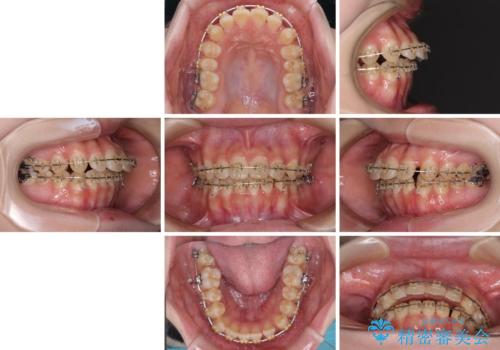 大学病院から転院 非抜歯で口元を下げるワイヤー矯正の治療前