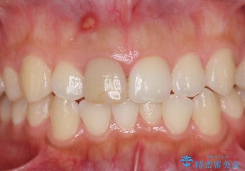 歯ぐきにできものができた 前歯の色調改善の治療前
