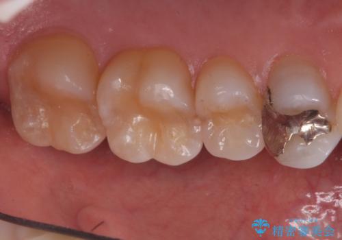銀歯と樹脂の詰め物のやり替え　セラミックインレーでの治療の治療前