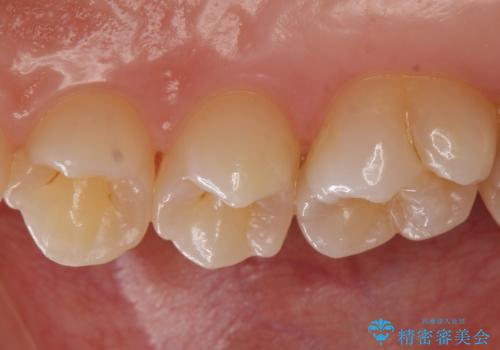 歯と歯の間の虫歯 セラミックインレーでの治療の治療前