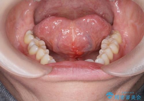 滑舌を改善したい　舌小帯の形成術の治療後
