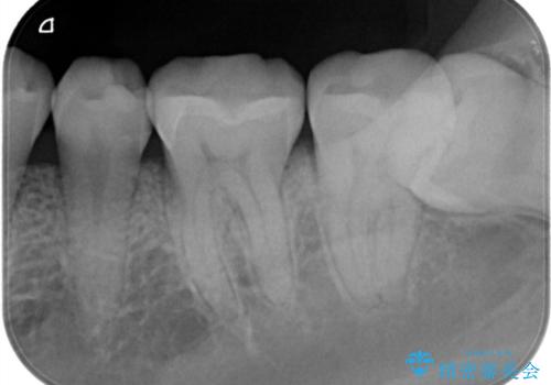 定期検診で虫歯発見。セラミック治療の治療後