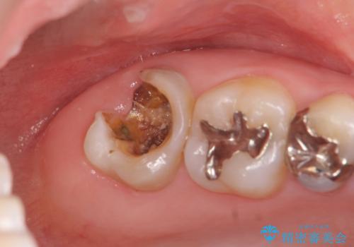 放置した虫歯を外科を行い抜歯を回避の症例 治療前