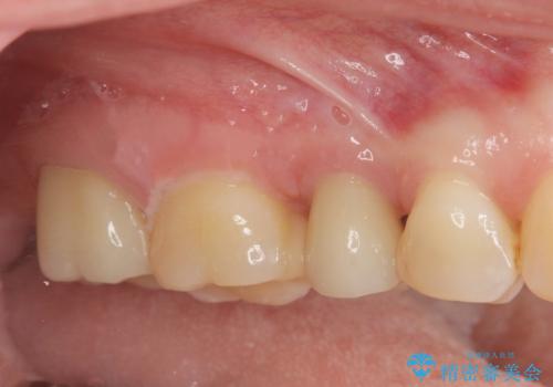 放置した虫歯を外科を行い抜歯を回避の治療後