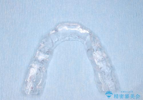 歯ぎしり いびきに効果的なスプリントナイトガード