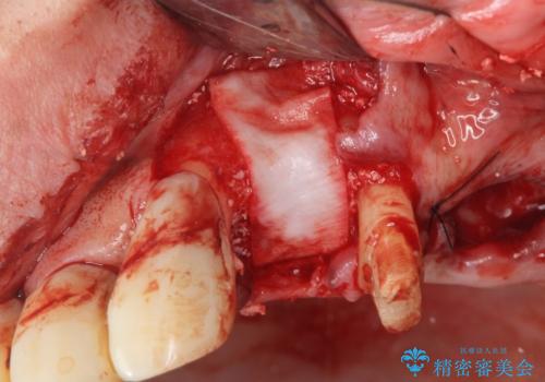 骨の造成を行った上顎インプラント治療の治療前