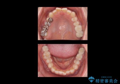 歯科でトラウマ 怖くて行っていなかったが、今度こそきちんと治療したいの治療後