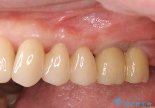 強い咬合力に対抗する歯周補綴の症例 治療後