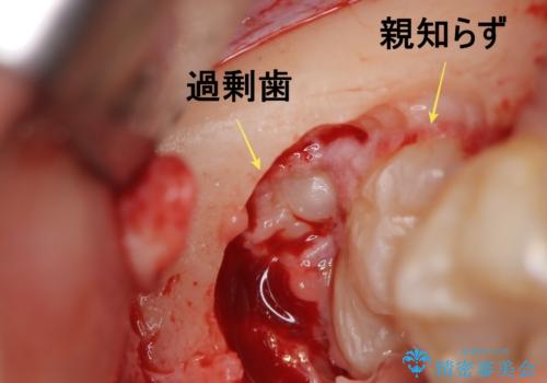 【埋伏智歯と埋伏智歯の過剰歯の抜歯】埋まっている親知らず2本の抜歯