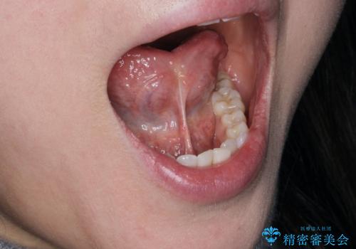 滑舌を改善したい 舌小帯の形成術の症例 治療前