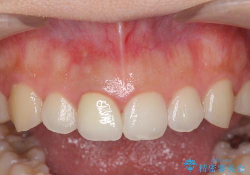 歯ぐきにできものができた 前歯の色調改善の治療後