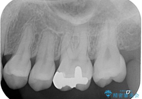 メタルフリーにしたい。の治療前