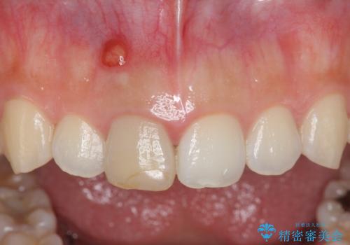 歯ぐきにできものができた　前歯の色調改善の治療前