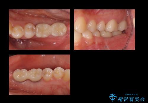 歯科でトラウマ 怖くて行っていなかったが、今度こそきちんと治療したいの症例 治療後