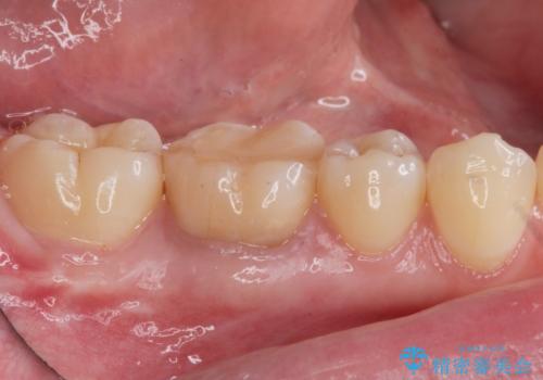 樹脂をセラミックにしたい ジルコニアクラウンでの治療の治療前