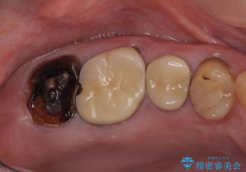 根管治療・歯周外科を行い歯を残した、複合的虫歯治療の治療前